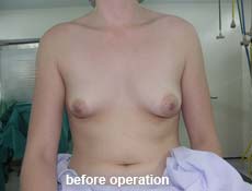 plastic-surgery-breast-augmentation 